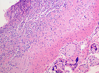 Estudio Patológico de Placenta