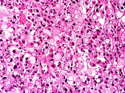 Patología Gastrointestinal y Biopsias Digestivas