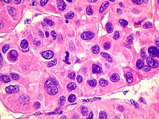 Patología Hepatobiliar y Pancreática de Precisión