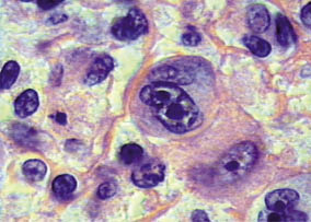 Biopsia de Ganglio Linfático y Hematopatología