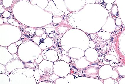 Diagnóstico de Tumores de Partes Blandas